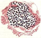 Duas Palavras Sobre a Doena De Chagas